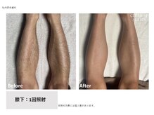 フェムーン(FEMOON)/清潔感アップ♪モテ脚脱毛