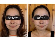 りせる整体院(Recell)/小顔矯正５回目　変化