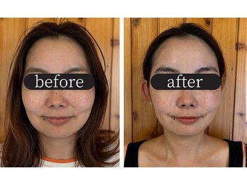 りせる整体院(Recell)/小顔矯正5回目 変化