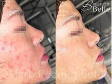 ベル 宇都宮(Belle)/ハーブピーリング｜ニキビケア
