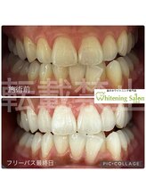 ホワイトニングサロン 広島店/【ホワイトニング施術例】