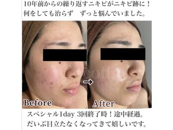 ココティー 大阪店(Cocotii)/スペシャル1day3回のケアの変化