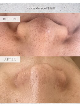 サロンドソエ(Salon de Soe)/毛穴洗浄