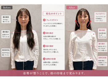 美整庵 谷山店(BISEIAN)/姿勢改善×小顔矯正before after