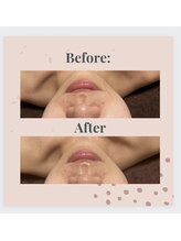 マオ(mao)/毛穴洗浄ハイドロピーリング