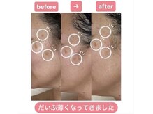 アフロディーテ(Aphrodite)/シミケア