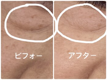 ノーブル シャット Noble Chate/諦めていた目の下のたるみ