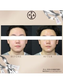 ココ センガ ビューティー クリニック(COCO SENGA Beauty-Clinic)/韓国肌管理プラピール効果写真