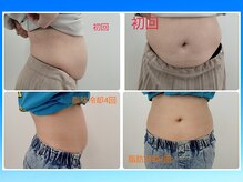 縁(en)の雰囲気（脂肪冷却4回で激減の脂肪♪）