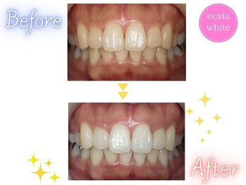 エクシアホワイトニング 四日市店/ホワイトニングビフォーアフター