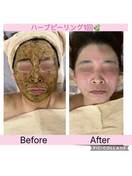 リンダ(Rinda)/50代ハクリ有ハーブピーリングBA