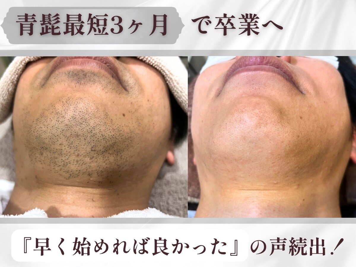 青髭速攻さよなら◎ 毎日の自己処理卒業【メンズ脱毛】ヒゲ脱毛(全体)