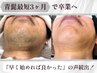 青髭速攻さよなら◎ 毎日の自己処理卒業【メンズ脱毛】ヒゲ脱毛(全体)