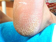 練馬フットケアセンター/◆ドイツ式トータルフットケア☆