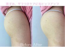 Cスキンケアクリニック 麻布店/光ヒップアップ #美尻 #桃尻 #尻