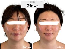 グロウズ(Glows)/頬のお肉のもたつきも改善