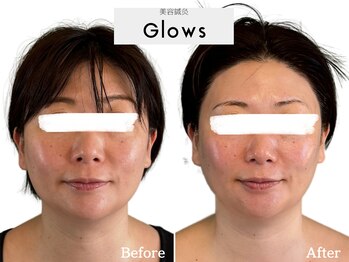 グロウズ(Glows)/頬のお肉のもたつきも改善