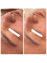 ラディエンス 多治見店/毛穴ケア