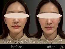 チョコバリ 郡山店(chocobari)/小顔×リフトアップ(美容鍼)20代