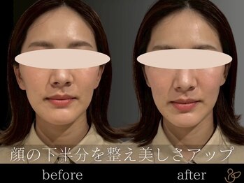 チョコバリ 郡山店(chocobari)/小顔×リフトアップ(美容鍼)20代