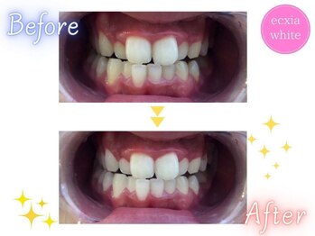 エクシアホワイトニング 四日市店/ホワイトニングビフォーアフター