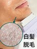 【メンズ脱毛/白髪】レーザー・光脱毛しても残る白髪髭にお困りの方　¥9,800