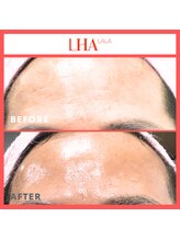 ビンナ(BINNA)/ビフォーアフター【ララピール】