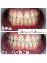 ホワイトニングサロン 京都烏丸店/ホワイトニング施術例