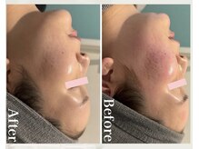 ルビー(Ruby)/【30代】ニキビ悩み・1回