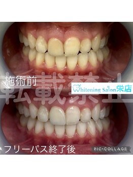 ホワイトニングサロン 名古屋 栄店/【ホワイトニング】
