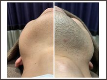 アンジェリーナの雰囲気（強冷却【ヒゲ脱毛】痛みを抑えて脱毛できます/30代12回の効果）