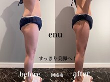 エヌ 白金台(enu)/enu4ステップ美脚トリートメント