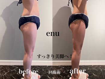 エヌ 白金台(enu)/enu4ステップ美脚トリートメント