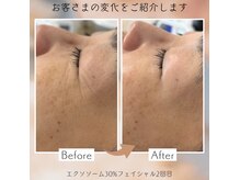 アネーロ(Anhelo)の雰囲気（【結果重視】エクソ30%［美白/シミシワ/たるみケア/小じわ改善）