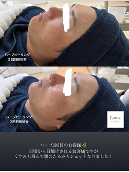 ロータス 千早香椎店(Lotus.)/ハーブピーリング2回目