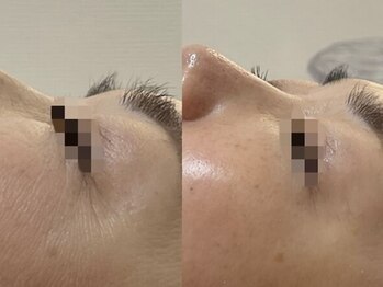 GRACETHOUSAND(グレイスサウザンド)/ハーブピーリング/洗浄/シワケア