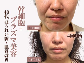 ベモーレ 谷町九丁目 上本町の写真/【速攻小顔】諦めていたホウレイ線・たるみ・肌のザラつきにアプローチ！最新プラズマ×脂肪分解ケア◎