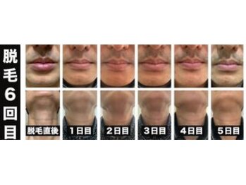 ウルル(Ululu)/【メンズ脱毛】脱毛経過　3ヵ月