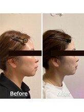 小顔22 ボルティ 赤坂支店(Bolty)/小顔シンメトリー矯正＆全身矯正