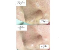 ビズビズ 梅田店(bisebise)/ニキビケア/ハイドラ毛穴洗浄