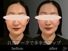 チョコバリ 郡山店(chocobari)/小顔×リフトアップ(美容鍼)20代