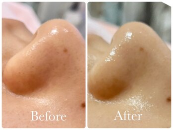 ヌー 栄(nuu)/ハイドラフェイシャル