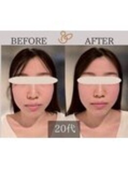 チョコバリ 錦糸町店(chocobari)/小顔×リフトアップ(美容鍼)20代