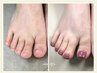 【女性限定】フット深爪矯正！通常メニュー(都度払い価格)