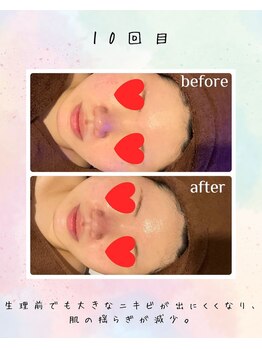 リリアン(lirien)/毛穴/毛穴ケア/毛穴洗浄/駒込