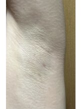 アイビークイーン(I.B.QUEEN)/嘘偽りのない終わりのある脱毛