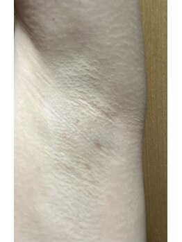 アイビークイーン(I.B.QUEEN)/嘘偽りのない終わりのある脱毛