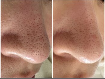 マヴィ くずは店(MavY.)/毛穴洗浄2回目