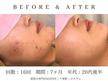 ロエヴェ(ROEWE)/ニキビ改善・毛穴ケア・肌質改善