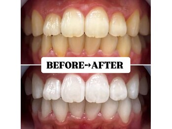 ホワイトニングサロン 豊中/Before&After美白ホワイトニング